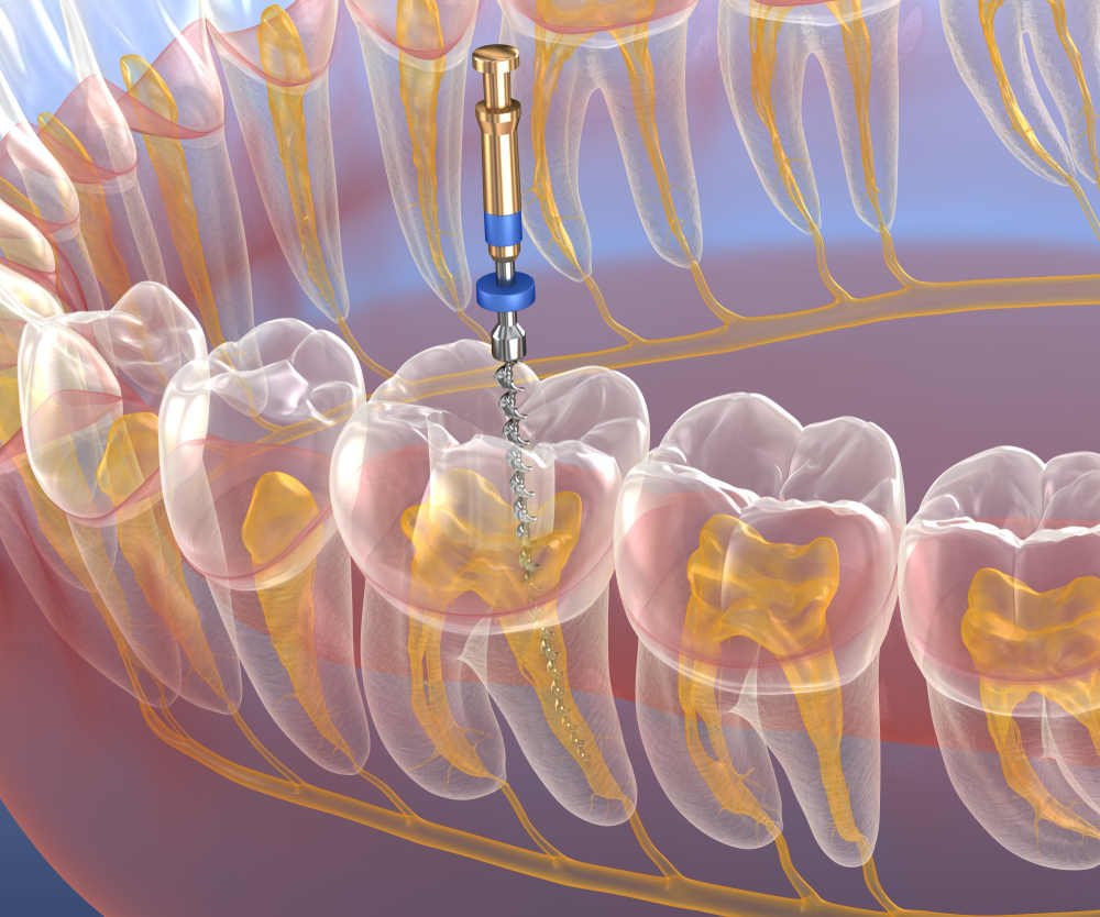 All About Endodontics